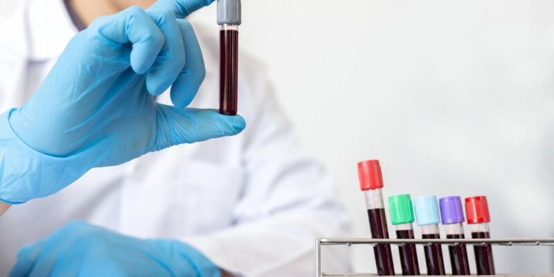 Can You Have Tuberculosis Without Symptoms Understanding TB Screening