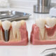 Single Dental Implant vs Fixed Bridge